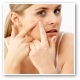 Acne - What is it?
