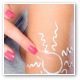 Eczema - What is it?