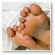 Fungal infection, otherwise known as Athlete's Foot (Tinea pedis)