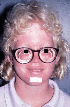 albinism in humans. Albinism-yellow mutant