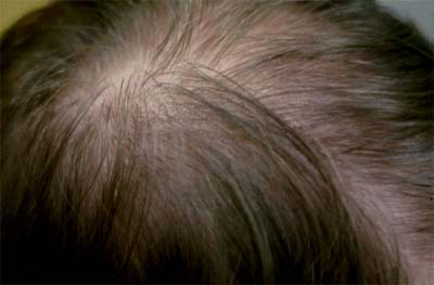 Androgenetic alopecia