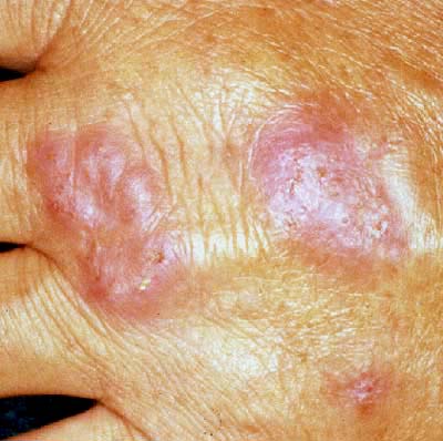 Atypical mycobacterium infection