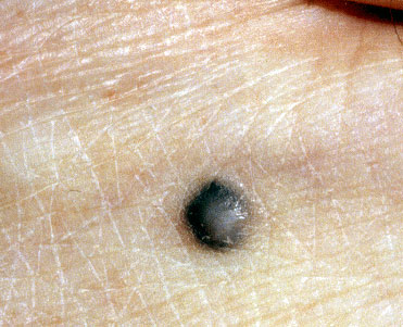 Blue Nevus - American Osteopathic College of Dermatology ...