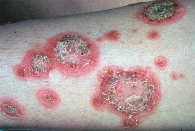 Bullous Impetigo