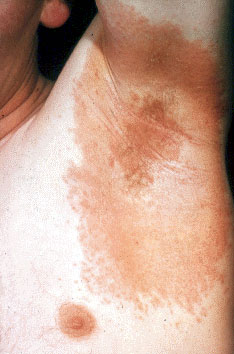 Contact dermatitis allergic