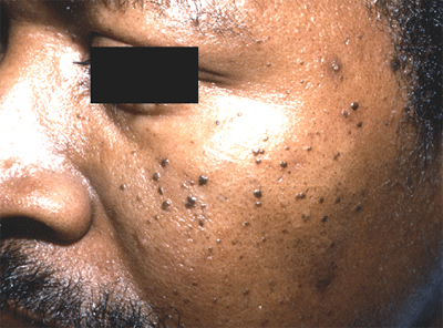Dermatosis papulosa nigra