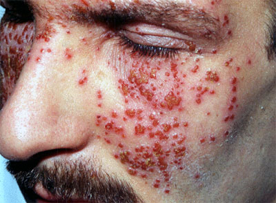 Dermatitis Herpetiformis Photos - Dermatology Education