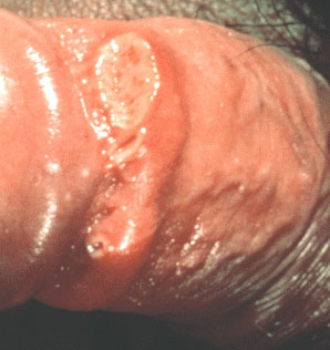 granuloma inguinale