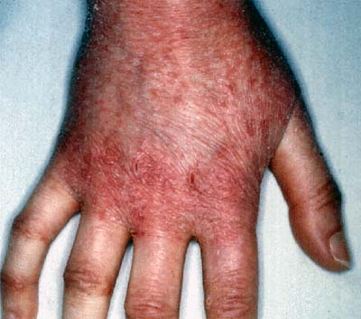 irritant contact dermatitis