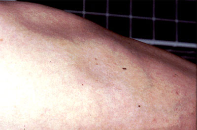 lupus erythematosis systemic