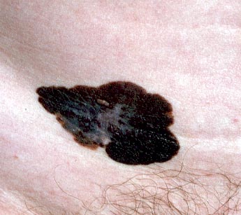 melanoma superficial spreading