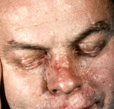 nevoid basal cell carcinoma