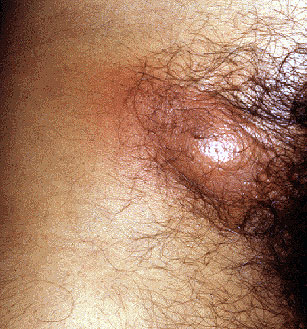 воспаление лимфоузлов при сифилисе