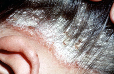 scalp psoriasis
