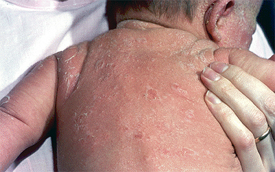 staphylococcal scalded skin syndrome