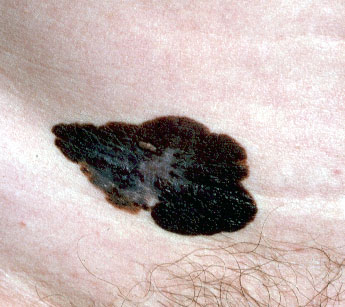 superficial spreading melanoma