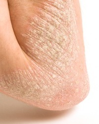 Psoriasis