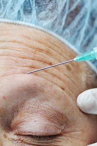 Juvederm - soft tissue filler