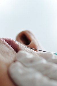Sculptra Treatment Overview