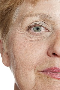 Skin Folds Treatment