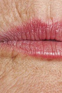 Upper Lip Wrinkling Treatment